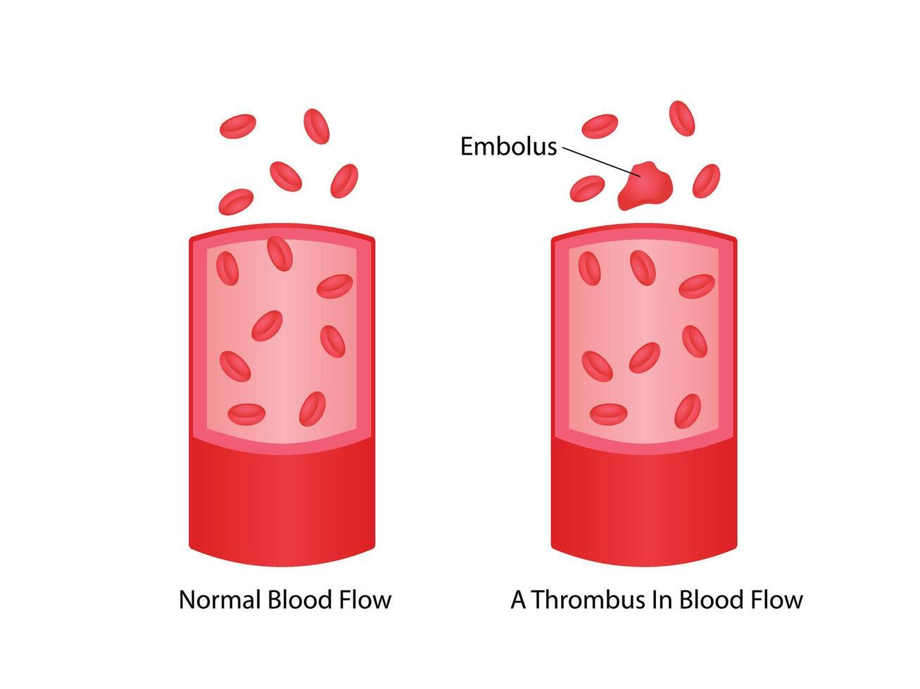 Thromboembolism. Normal blood flow and a thrombus in blood flow vector