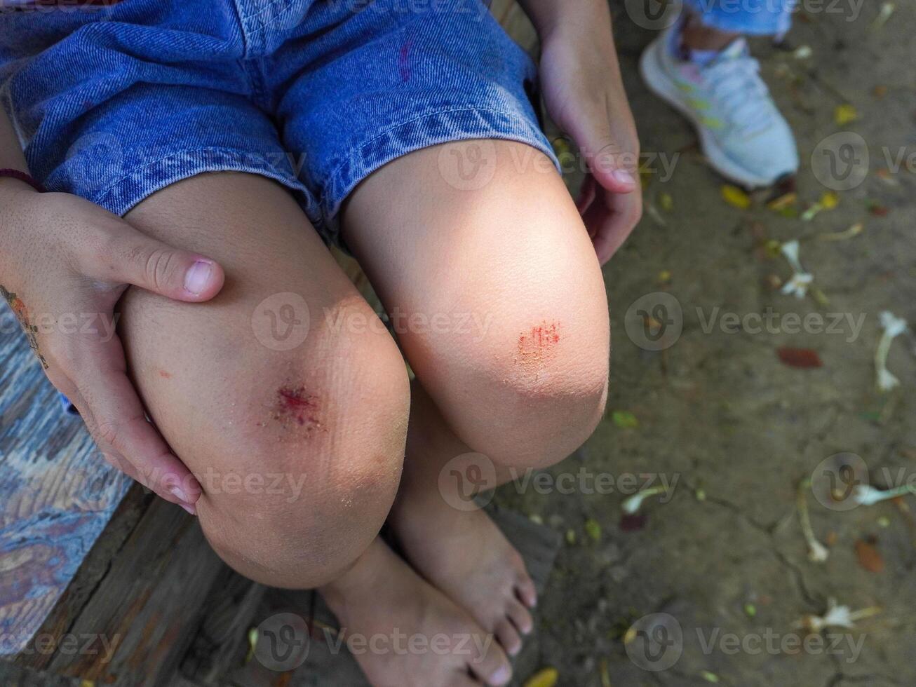 A young girl injured her knee while playing outdoors on a playground. Wounded knee of the child. photo