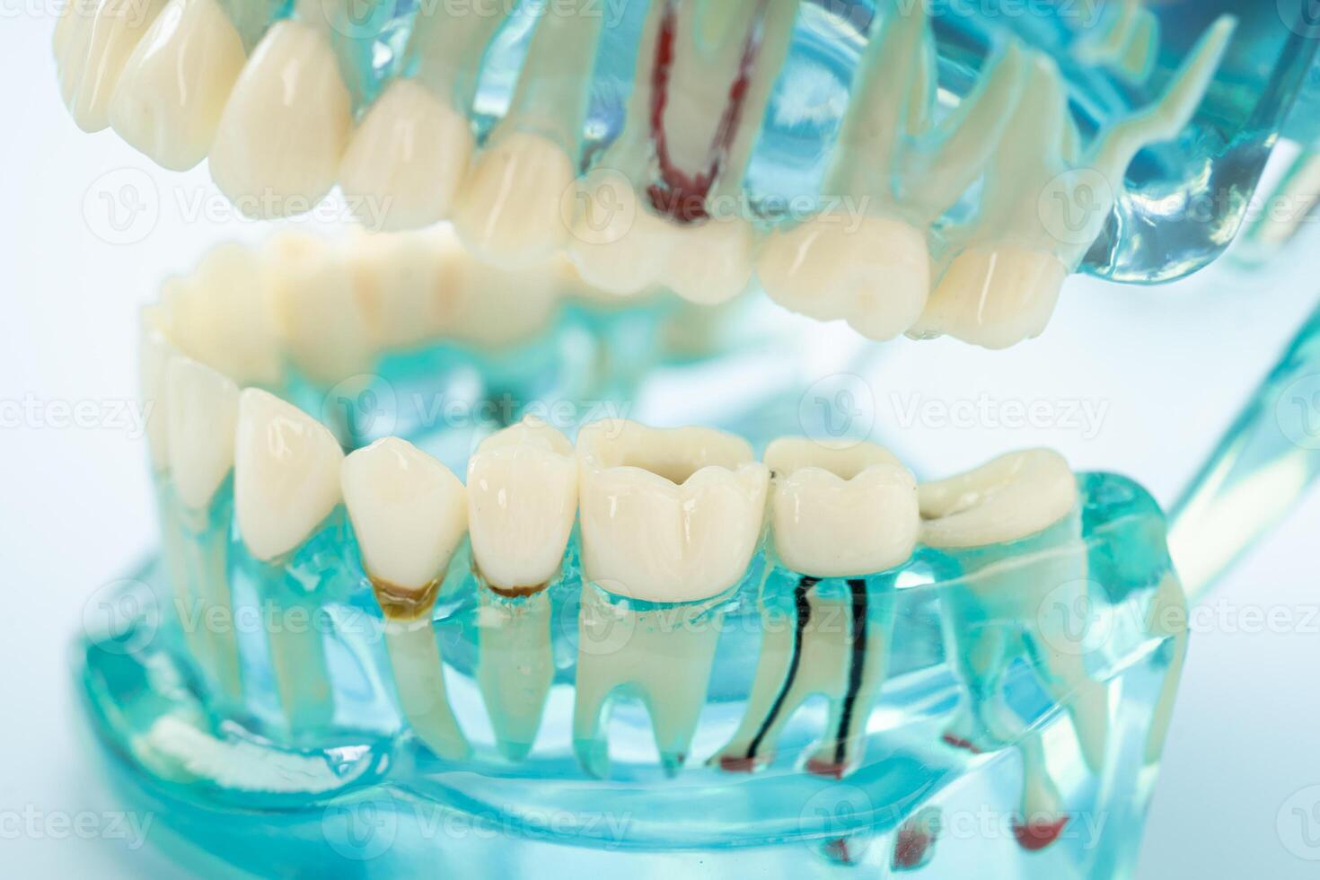 Dental implant, artificial tooth roots into jaw, root canal of dental treatment, gum disease, teeth model for dentist studying about dentistry. photo