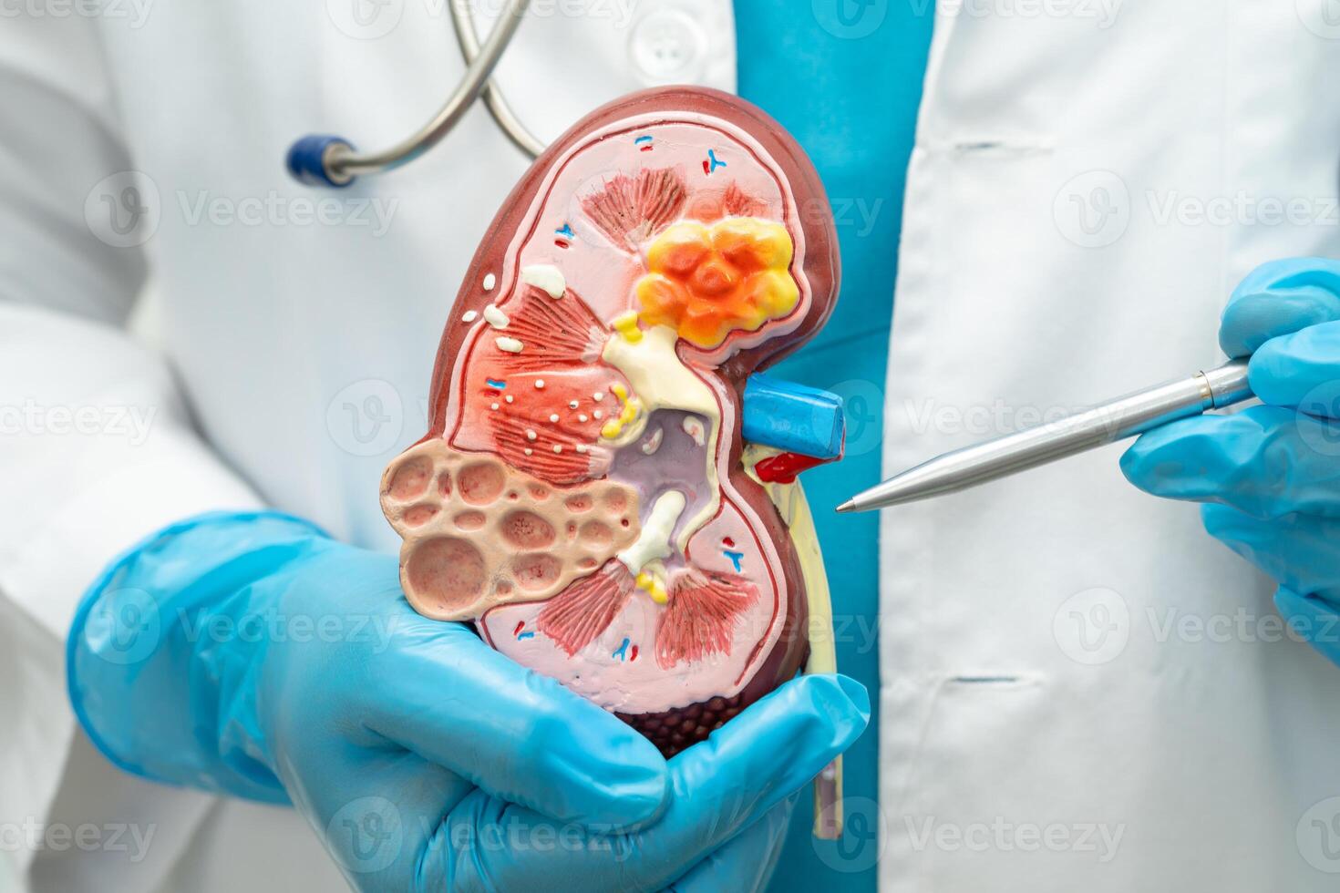 Kidney disease, Chronic kidney disease ckd, Doctor hold human model to treat and study in hospital. photo