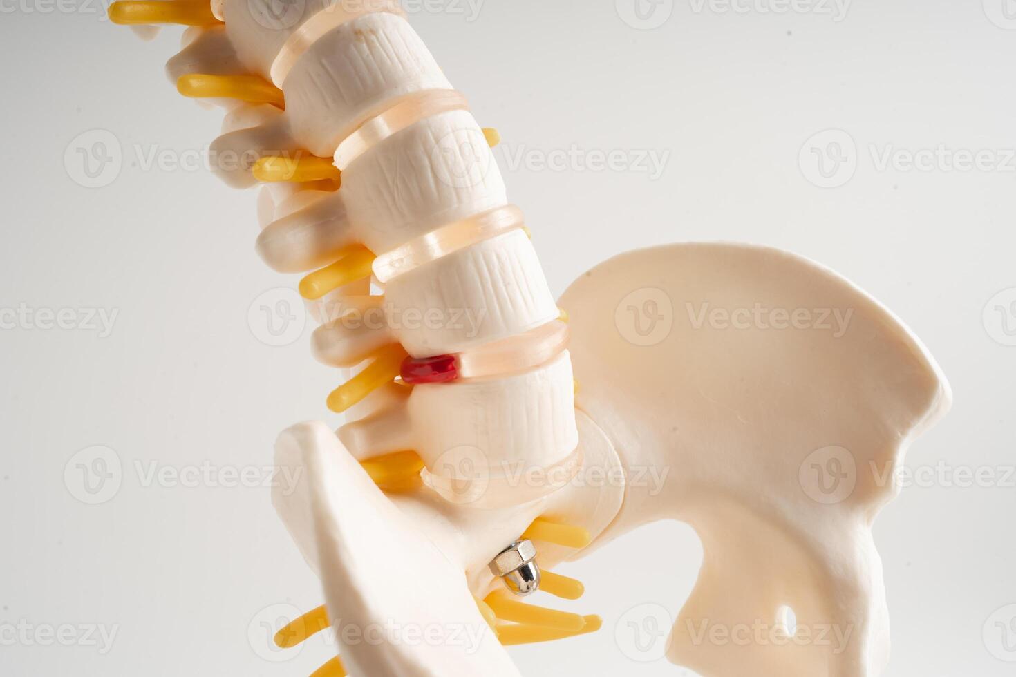 Lumbar spine displaced herniated disc fragment, spinal nerve and bone. Model for treatment medical in the orthopedic department. photo