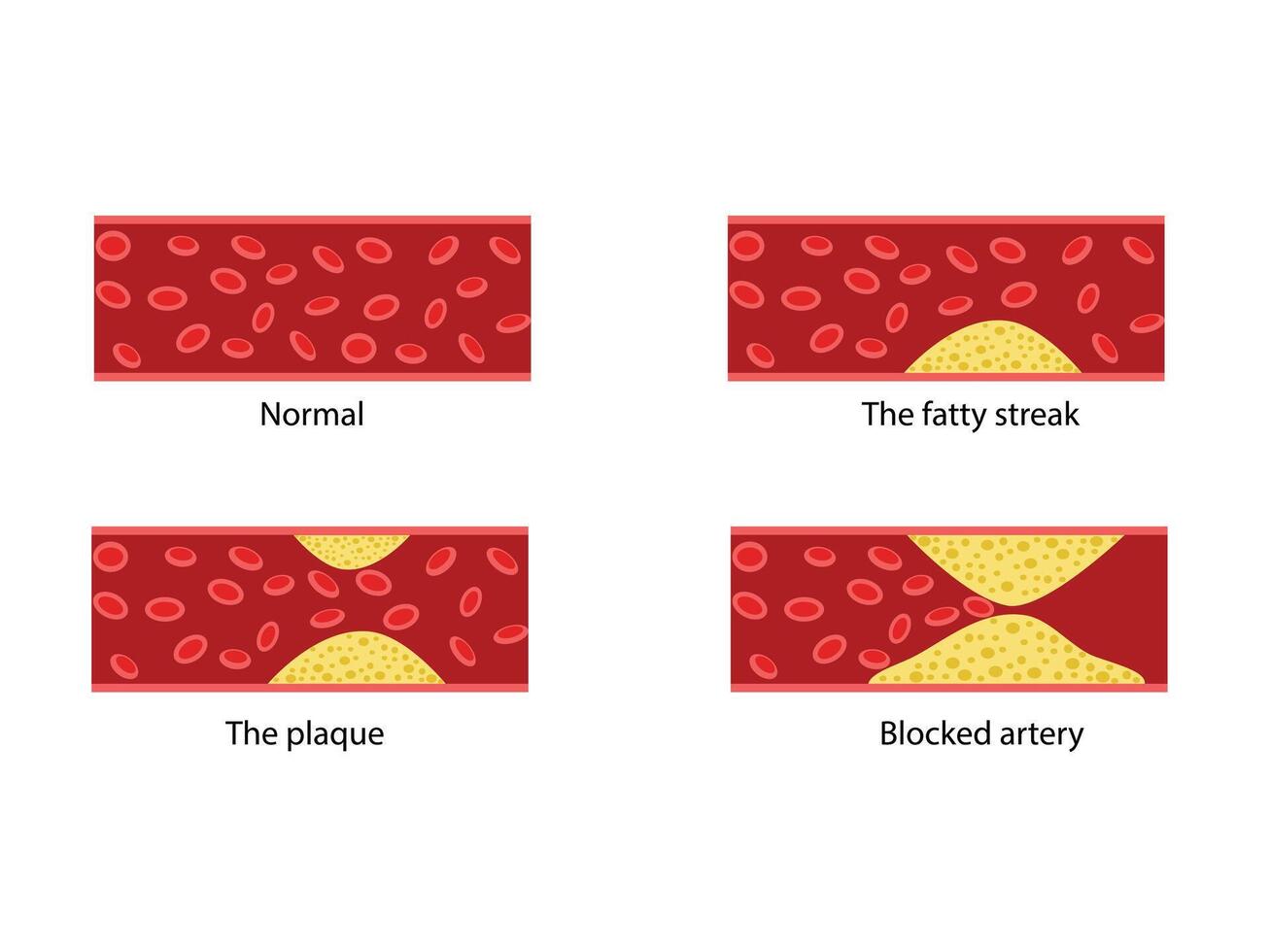 Cholesterol in human blood vessels. Normal artery, fatty streak, plaque, blocked vascular vector