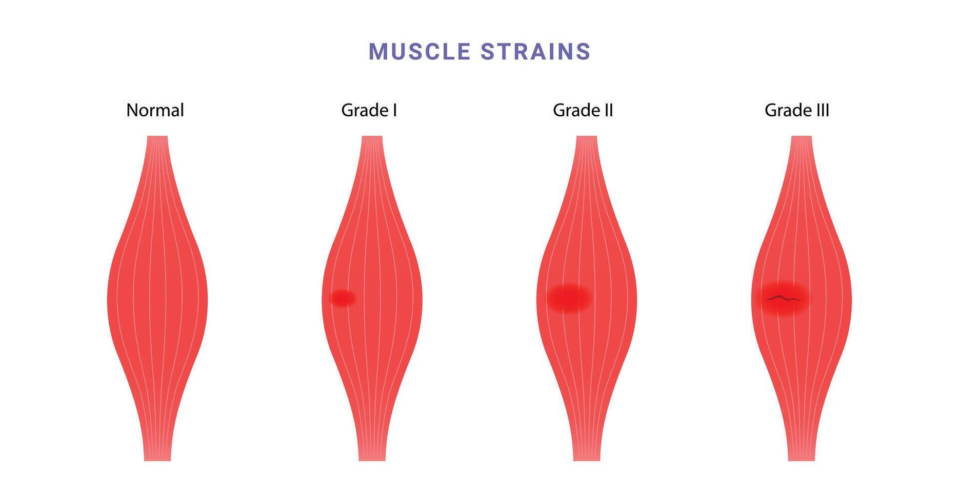 Muscle strain grading science diagram vector
