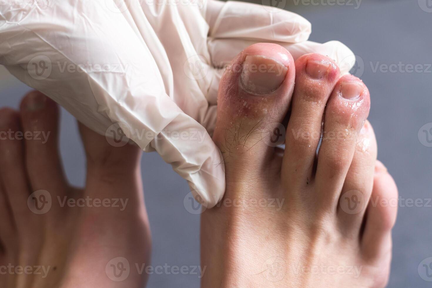 A white man holding his toes, showing what looks like a rash with red blotchy skin. A common side effect of Covid-19 often referred to as Covid toe photo