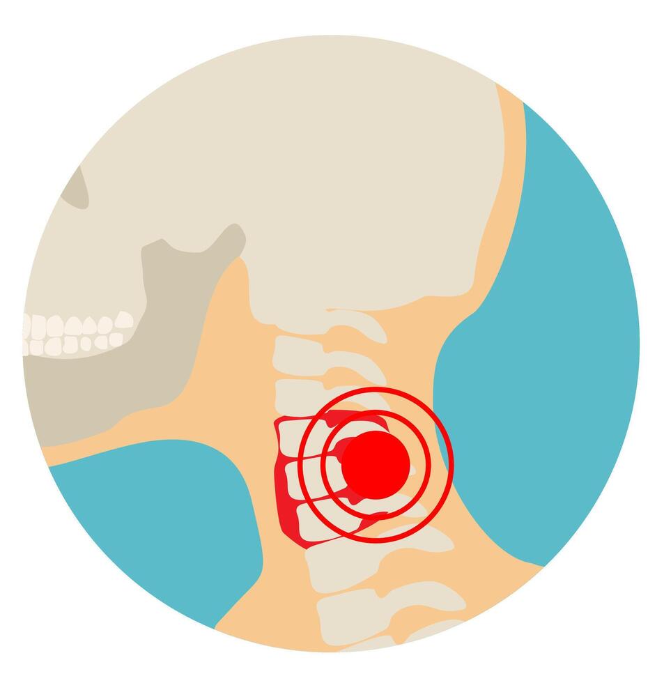 Cervical spine have a red signal. Neck disease, neck injury. Rheumatoid arthritis swelling of. Illustration about diagnose body injury. Flat style vector