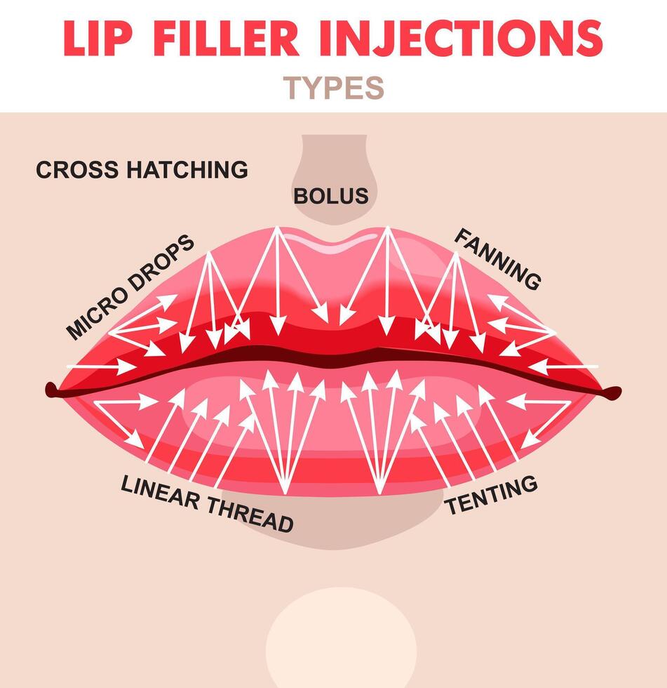 Lip injection hyaluronic acid filler. Hyaluronic acid lip injections scheme. Detailed filler injection scheme in colours. Medical, cosmetological and anti-aging concept vector