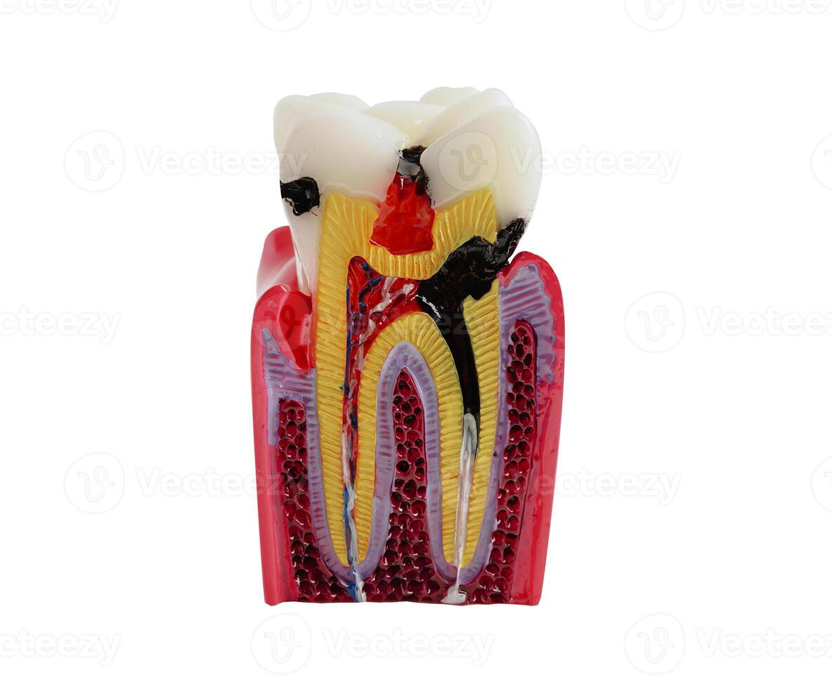 Dental implant, artificial tooth roots into jaw isolated on whtie backgroud with clipping path. photo