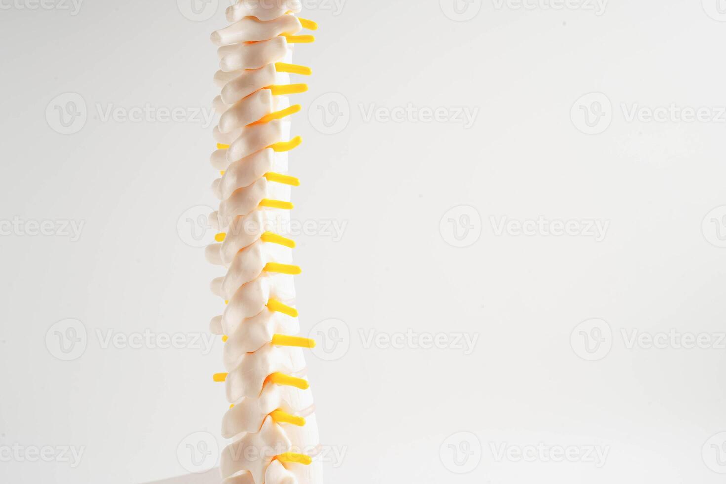 Spinal nerve and bone, Lumbar spine displaced herniated disc fragment, Model for treatment medical in the orthopedic department. photo