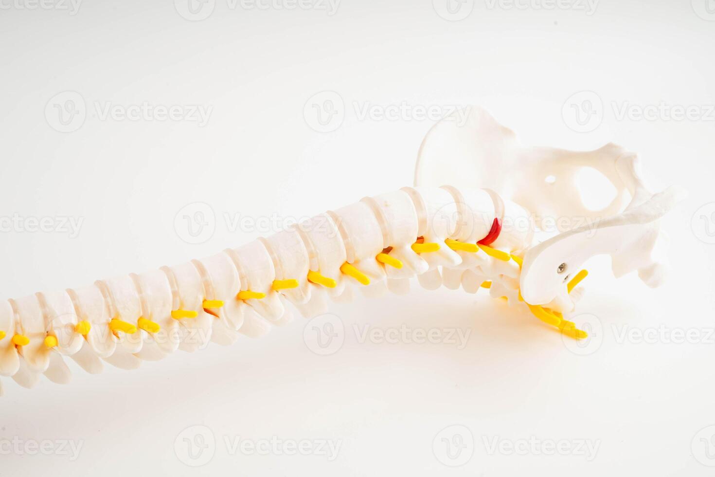 Spinal nerve and bone, Lumbar spine displaced herniated disc fragment, Model for treatment medical in the orthopedic department. photo