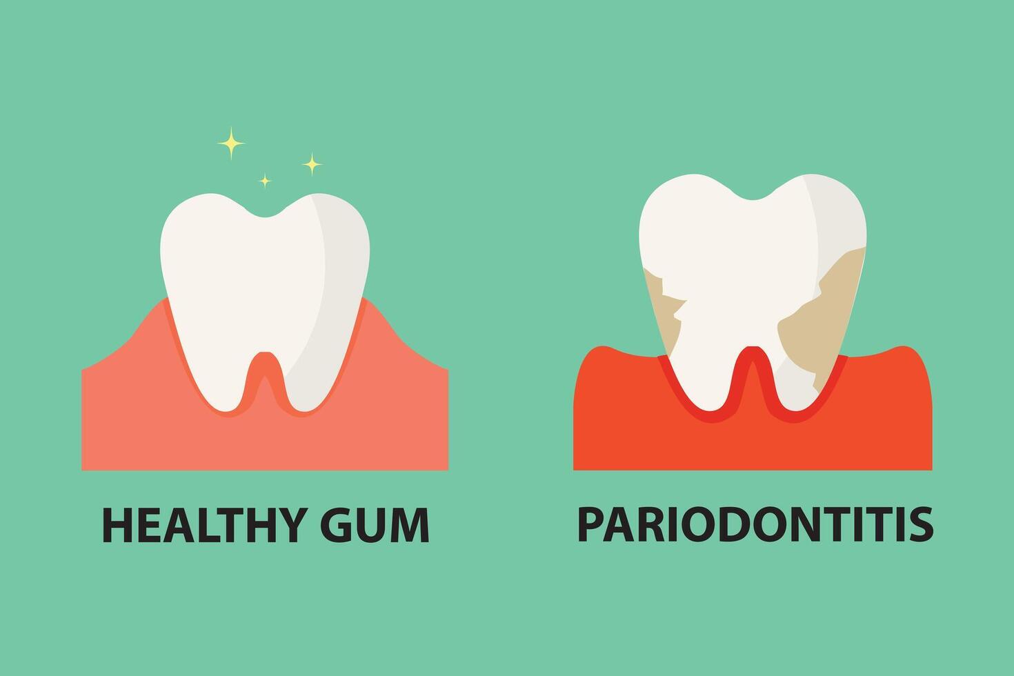 Stomatological concept. Comparison between healthy tooth and periodontitis tooth. vector