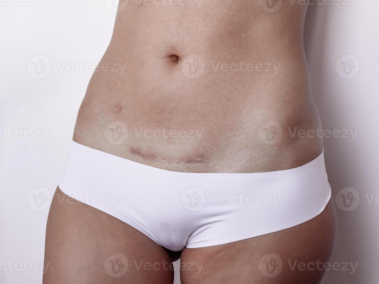 Post surgery recovery. Womans midsection with c section scar highlighting healing process photo
