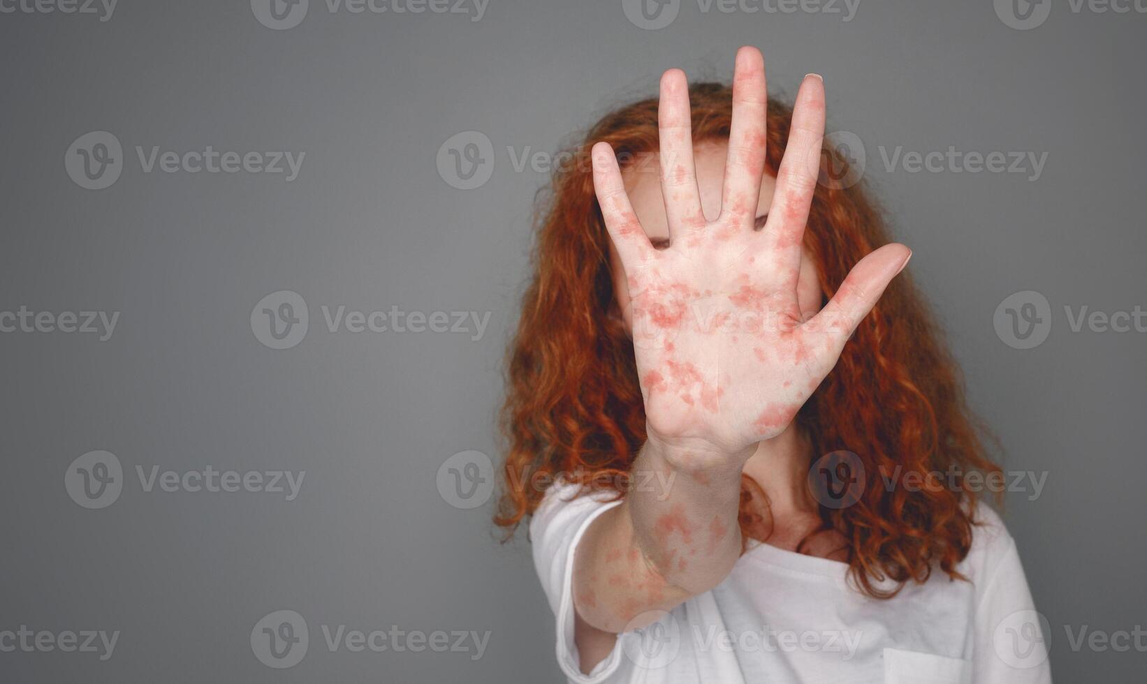Stop Measles. Woman With Red Spots On Palm Over Grey Background, Copy Space photo