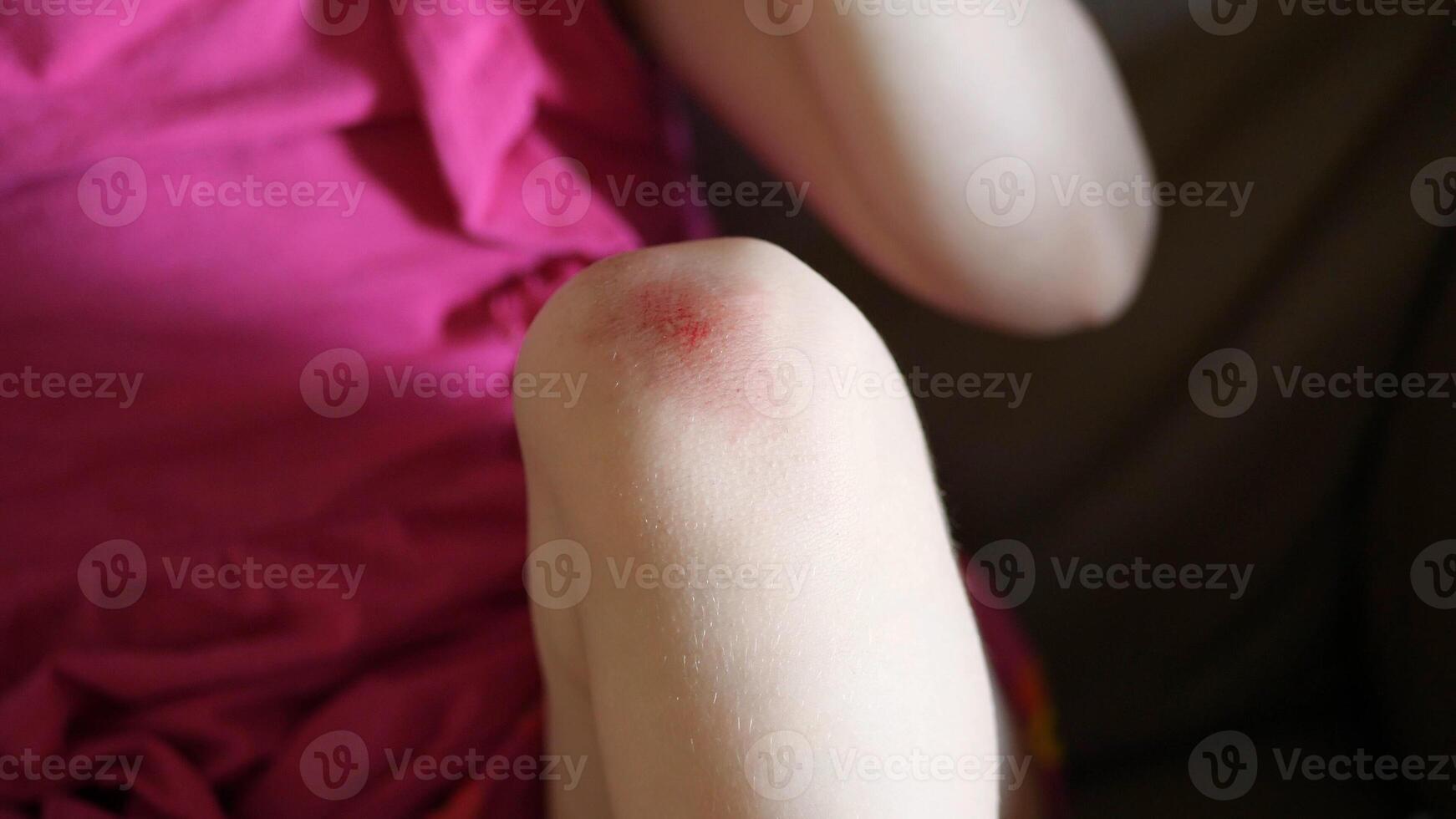 Wounded knee of the child, abrasions on the baby girl's knees. photo