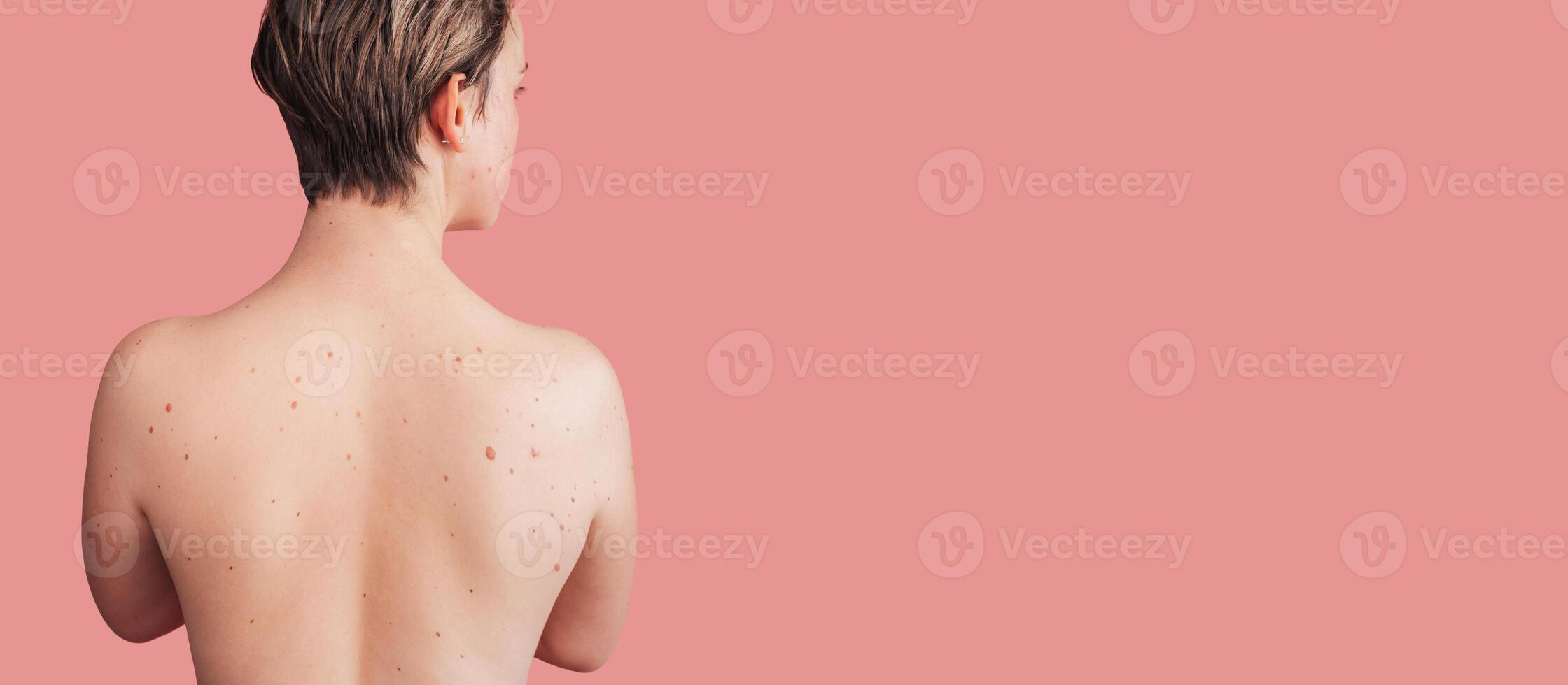 The back of a young woman with moles on the background. Without filters. Panoramic banner. A place for the text. photo
