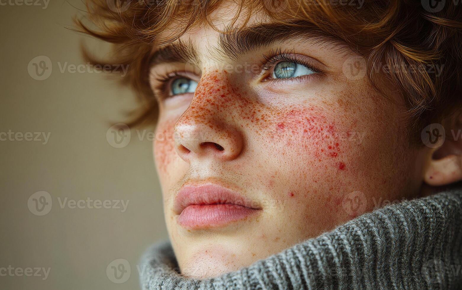 A young man with red spots on his face and blue eyes. He is wearing a gray sweater photo