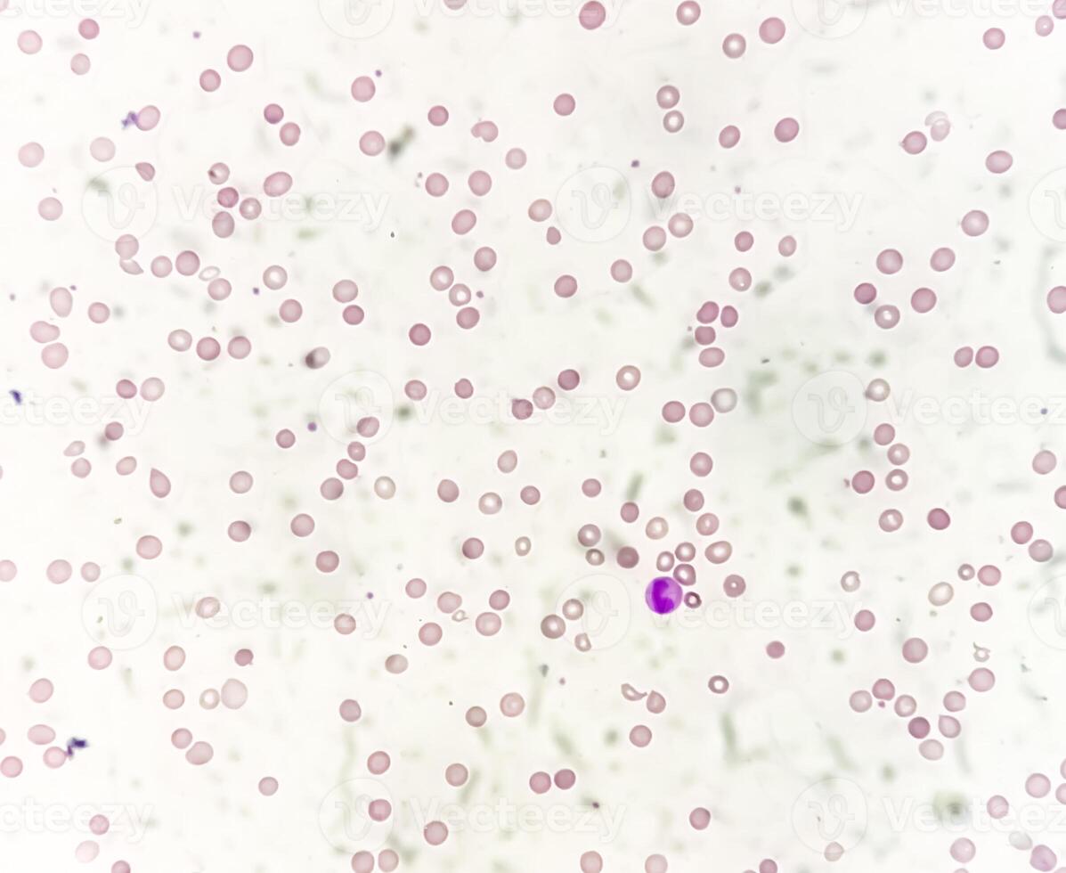 Photomicrograph of Leuco-erythroblastic anemia. 40X photo