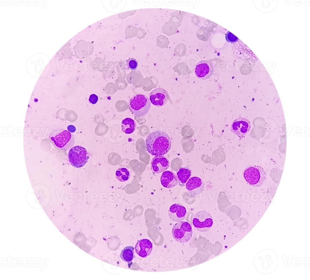 Bone marrow study, Suggestive of reactive marrow with dimorphic Erythroid hyperplasia photo