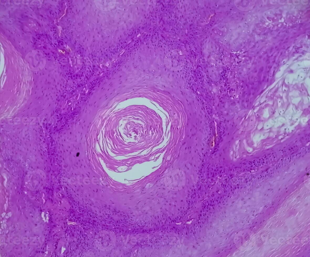 Histological biopsy of Scrotal wall under microscopy showing Calcinosis cutis. Scrotal calcinosis. Calcinosis cutis of scrotum photo