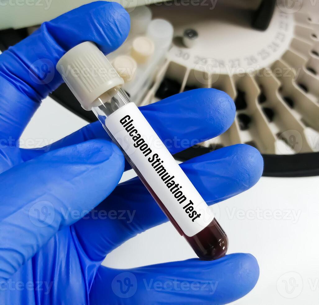 Glucagon Stimulation Test, Hypoglycemia a condition in which your glucose levels are lower than normal photo