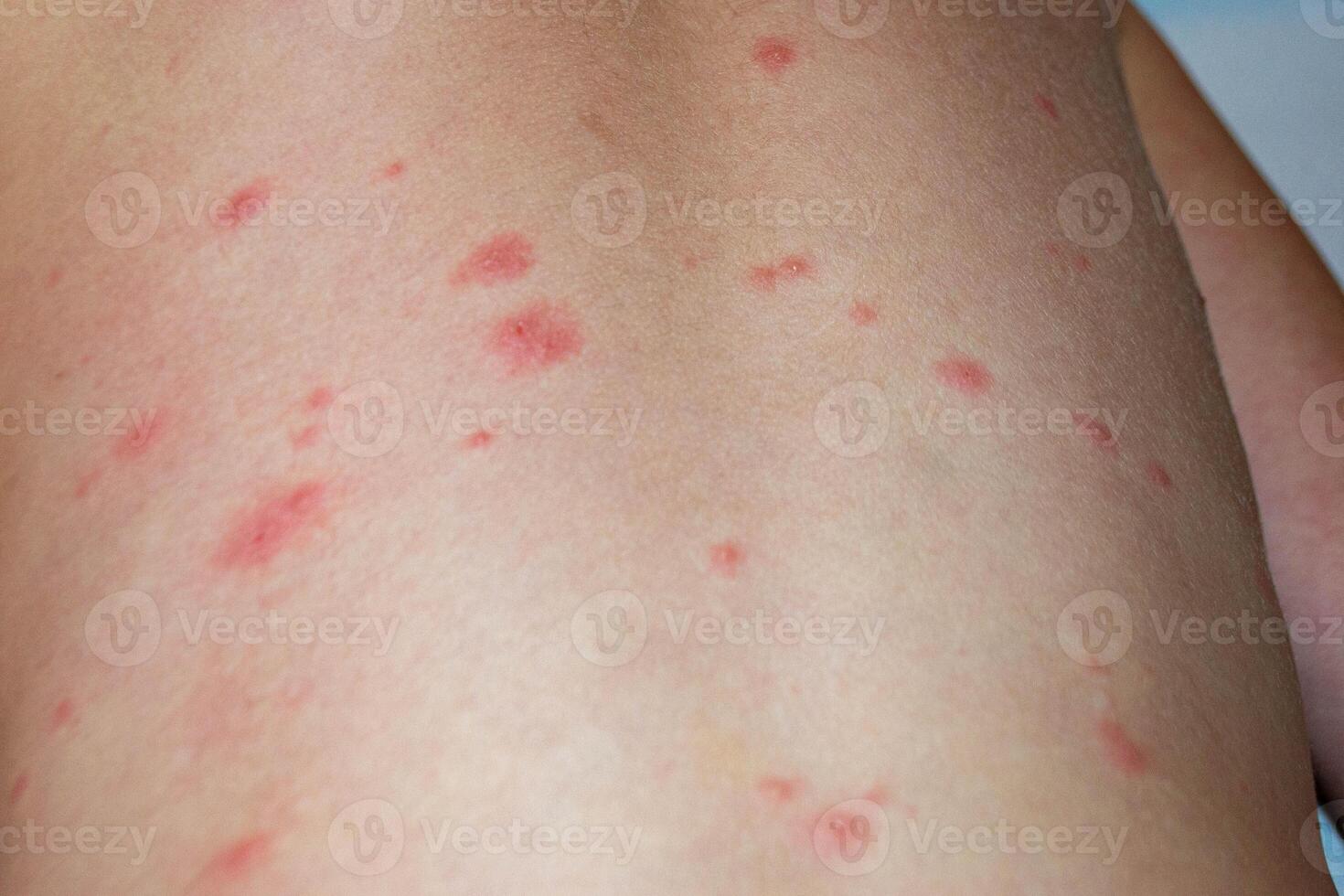 Varicella virus or Chickenpox bubble rash on child photo
