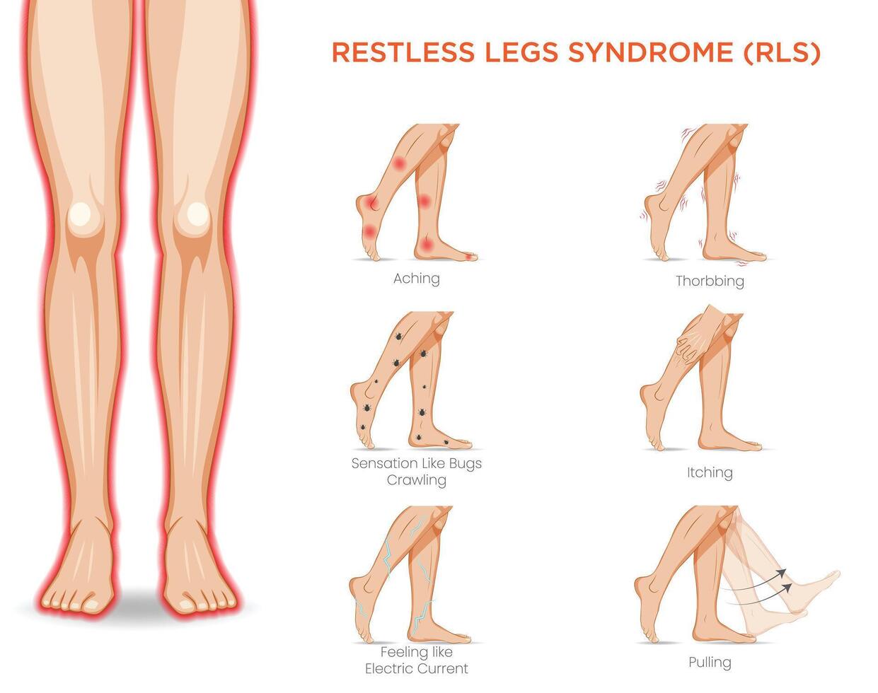 Restless Legs Syndrome Uncontrollable Urge to Move Legs with Discomfort, Especially at Night vector