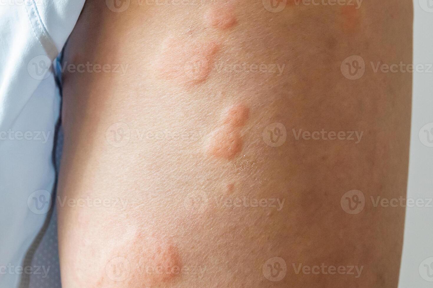 Young asian man has allergic skin rash on his legs from itchy dry skin eczema dermatitis insect bites photo