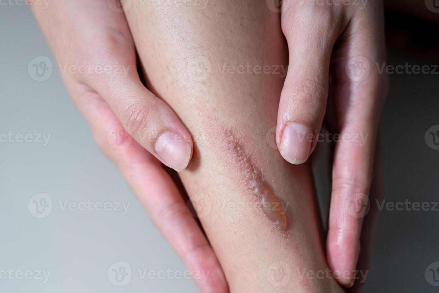Woman leg blistered and red skin from accidental scalds. photo