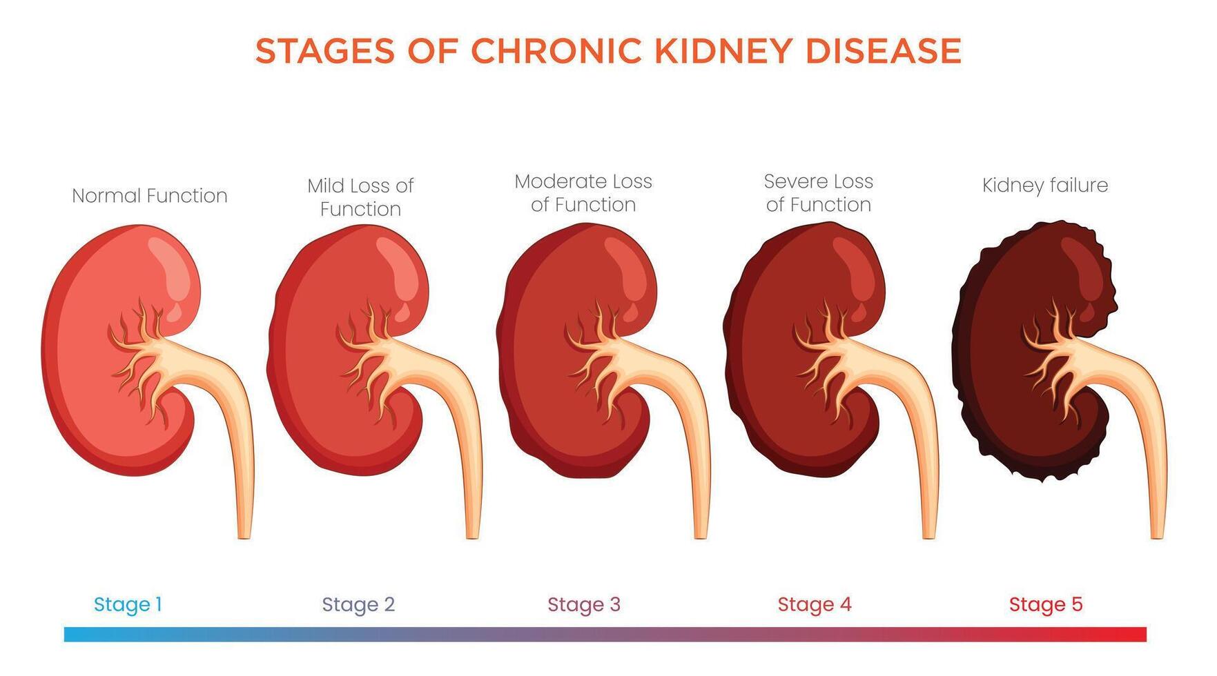 Stages of Chronic Kidney Disease Progression from Mild Impairment to Severe Renal Failure vector