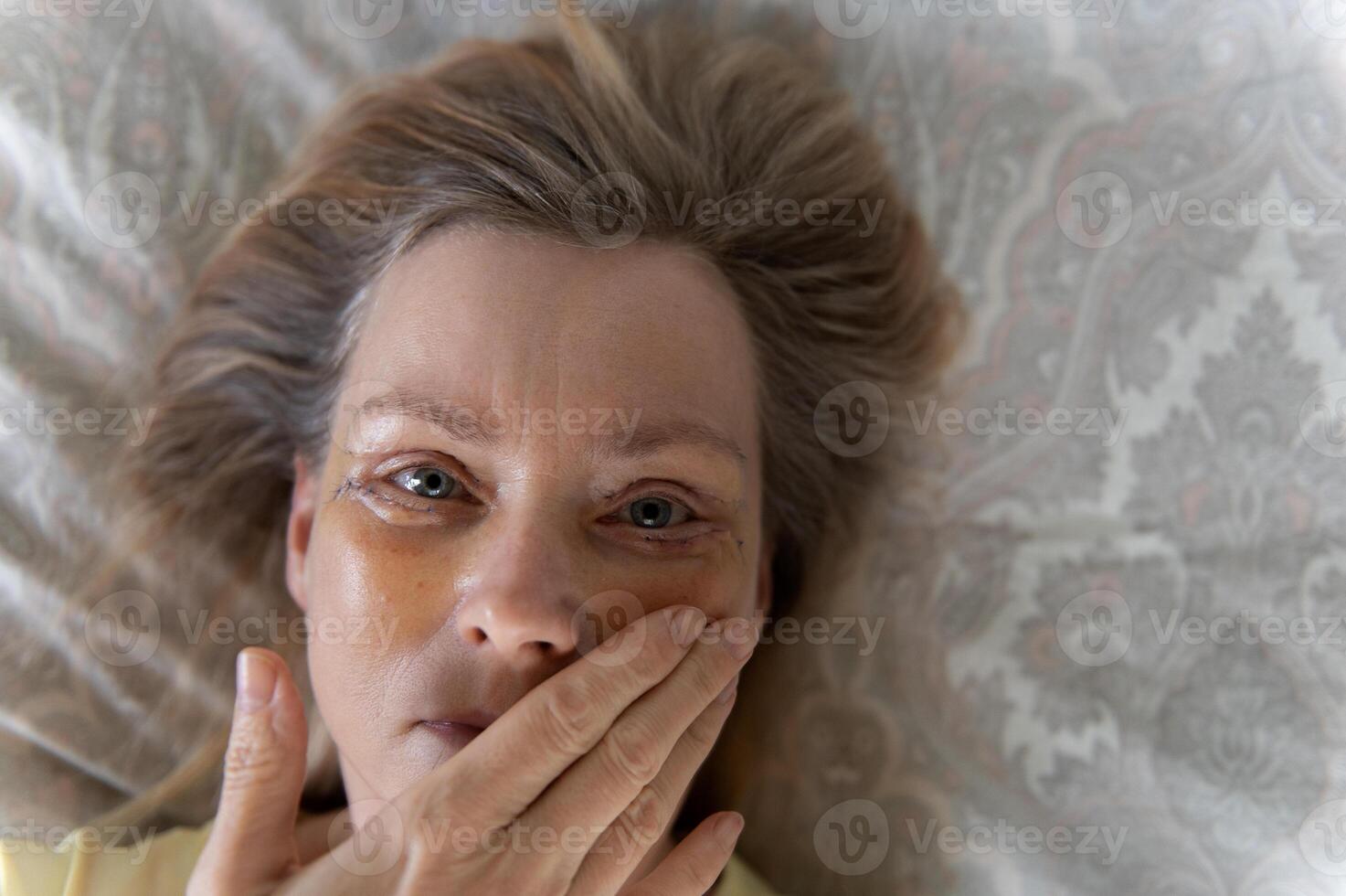 Middle-aged woman selfie seven days after double eyelid blepharoplasty surgery, top view photo