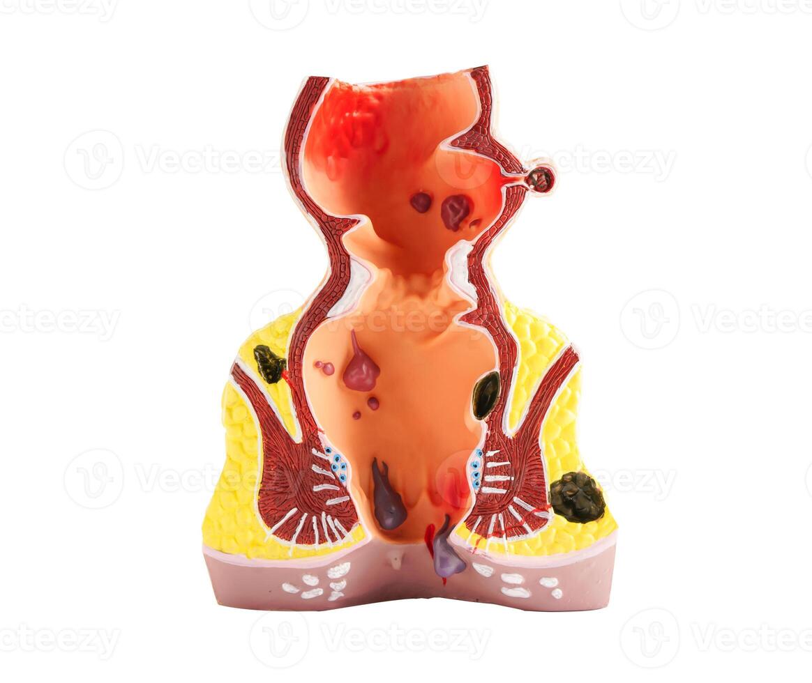 Rectum and hemorrhoid human anatomy model isolated on white background with clipping path. photo