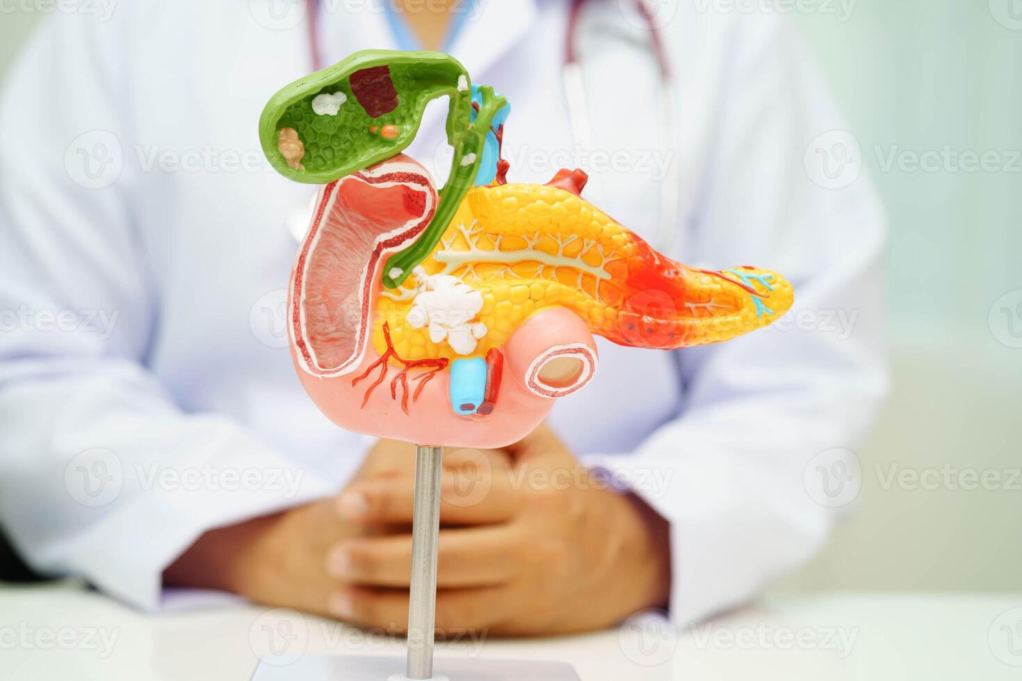 Pancreatitis, pancreatic cancer, Asian doctor with pancreas, gallbladder and bile duct human anatomy model at hospital. photo