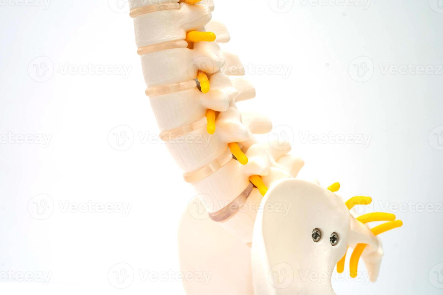 Spinal nerve and bone, Lumbar spine displaced herniated disc fragment, Model for treatment medical in the orthopedic department. photo