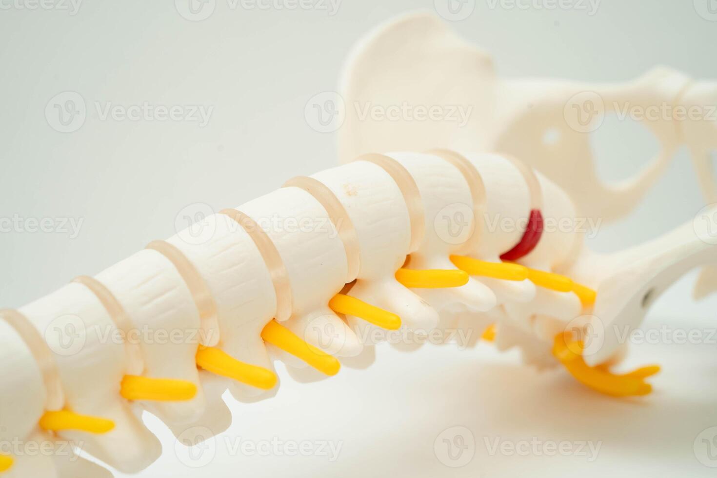 Spinal nerve and bone, Lumbar spine displaced herniated disc fragment, Model for treatment medical in the orthopedic department. photo