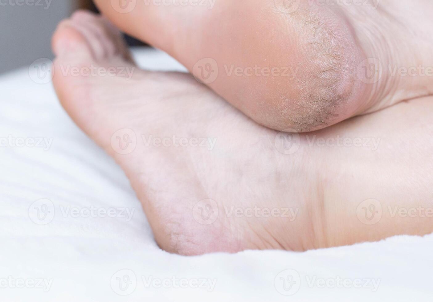 Dry cracked skin on the heels of a person s legs, close-up. The concept of serious skin diseases and kidney failure photo