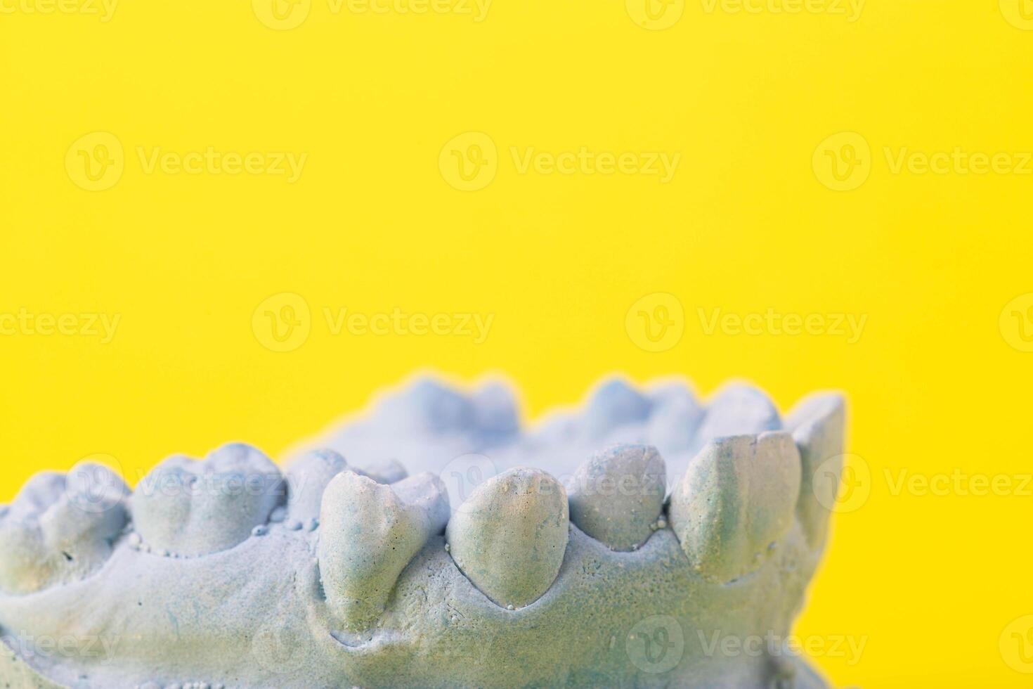 Blue plaster model of an impression of a patient's jaw at an orthodontist dentist on a yellow background. Manufacturing of dentures and crowns for dental prosthetics in orthodontics, macro. photo