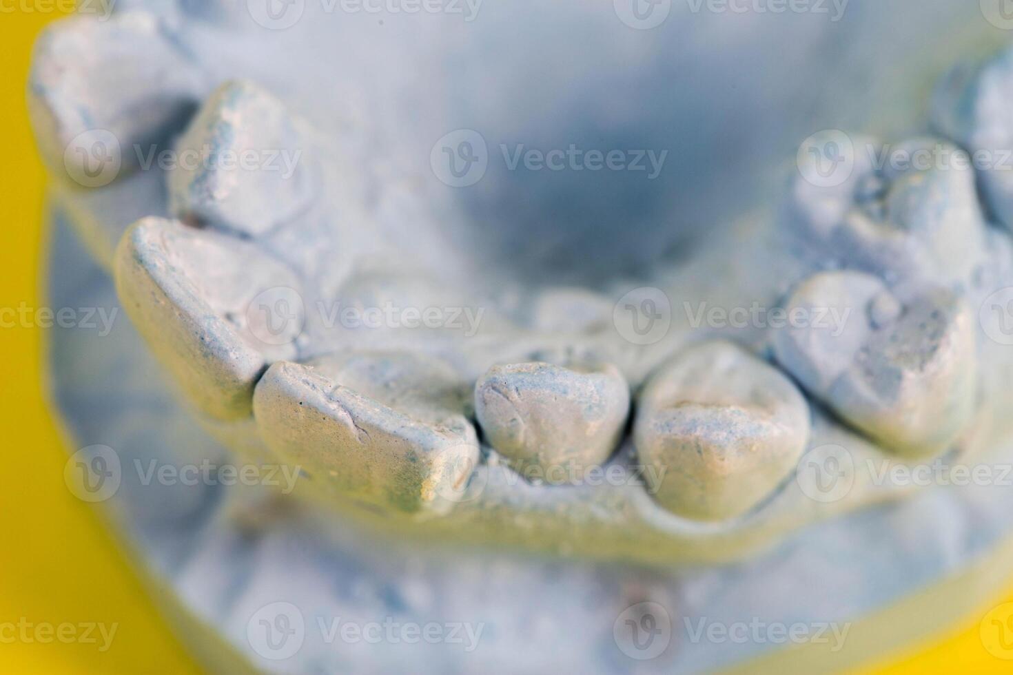 Blue plaster model of an impression of a patient s jaw at an orthodontist s dentist, close-up. Crooked teeth, correction of malocclusion, macro photo