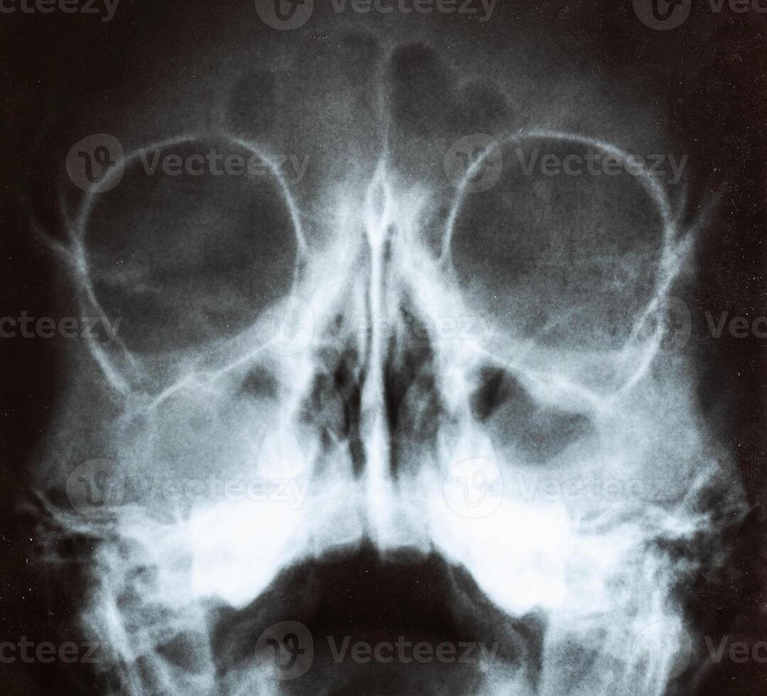 X-ray image of the skull of a child with purulent sinusitis, close-up. Treatment of inflamed sinuses, purulent secretion photo