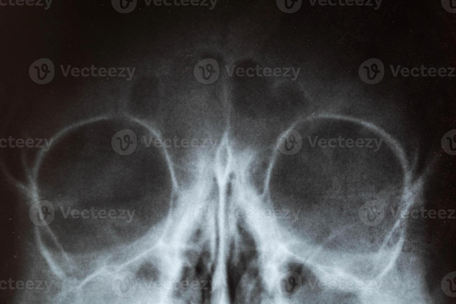 X-ray image of the skull of a child with purulent sinusitis, close-up. Treatment of inflamed sinuses, purulent secretion photo