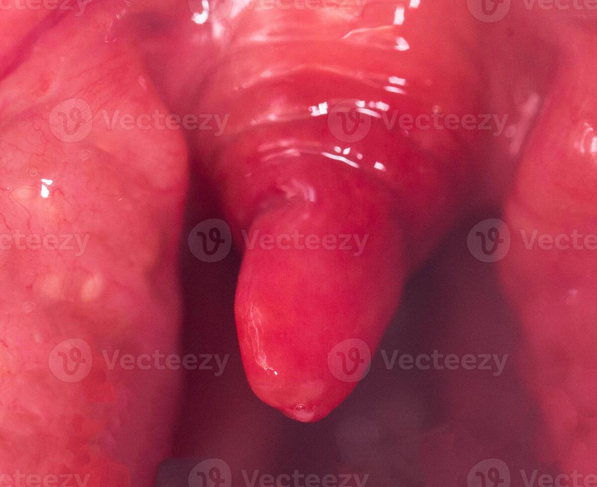 Long uvula with inflammation of infections and viruses. Treatment of uvulitis in children and adults. Sore throat, sore throat, macro. Allergy photo