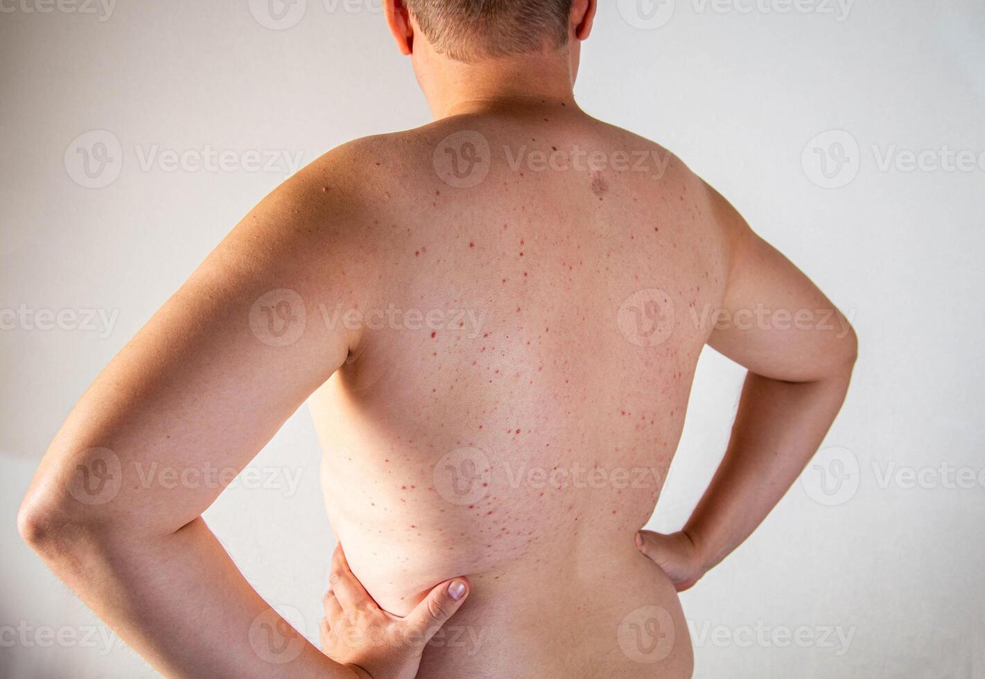 A man has a scar and red pimples on his skin due to poor hygiene. Inflammation of the sebaceous glands, close-up photo