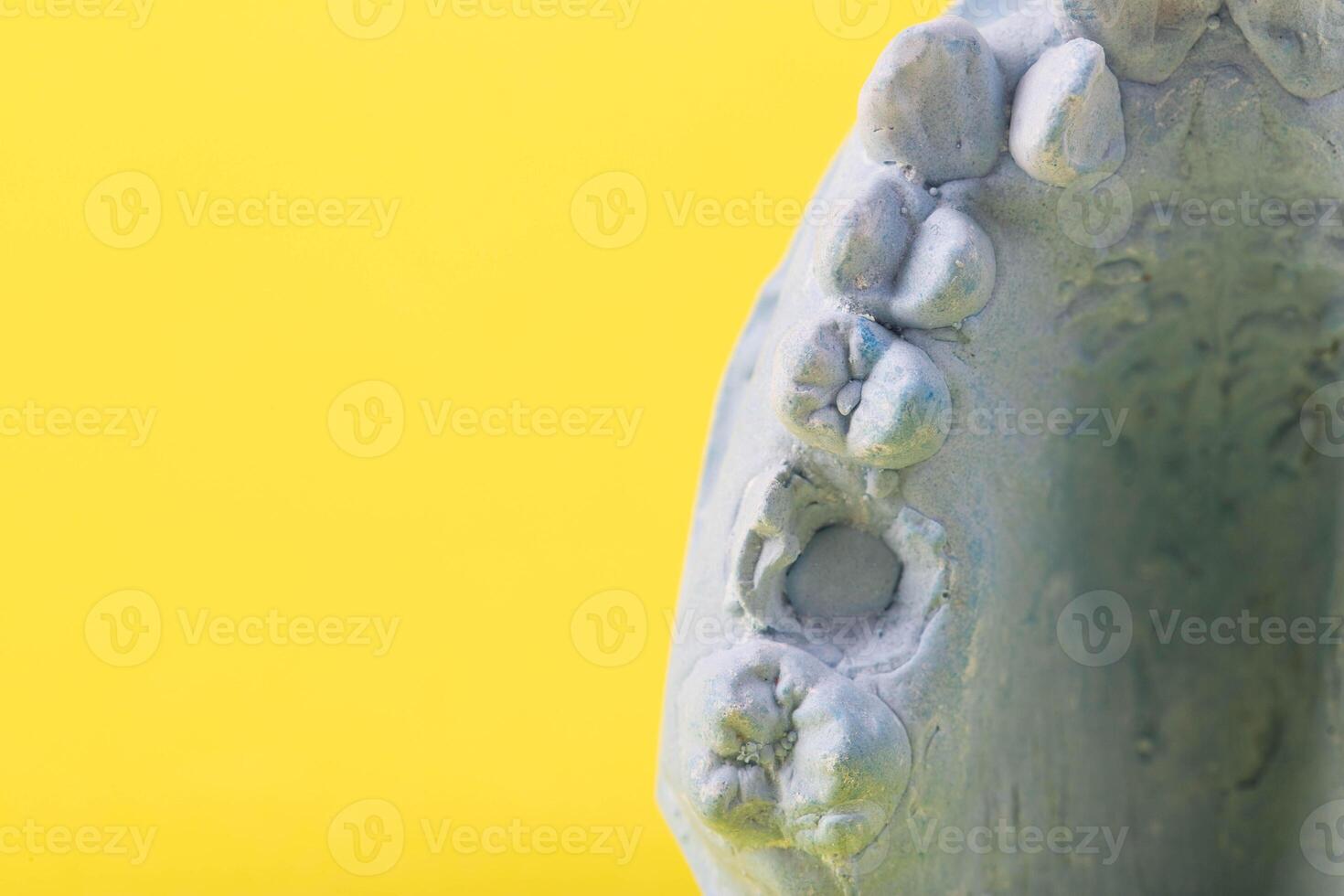 Blue plaster impression of a patient's dental jaw with crooked teeth and malocclusions on a yellow background. Manufacturing of braces to correct bite. View from above. Copy space for text photo