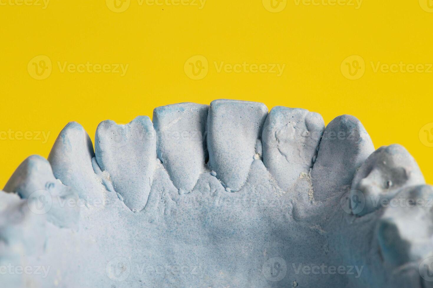 Blue plaster impression of a patient's dental jaw with crooked teeth and malocclusions on a yellow background. Manufacturing of braces to correct bite. View from above. Copy space for text photo