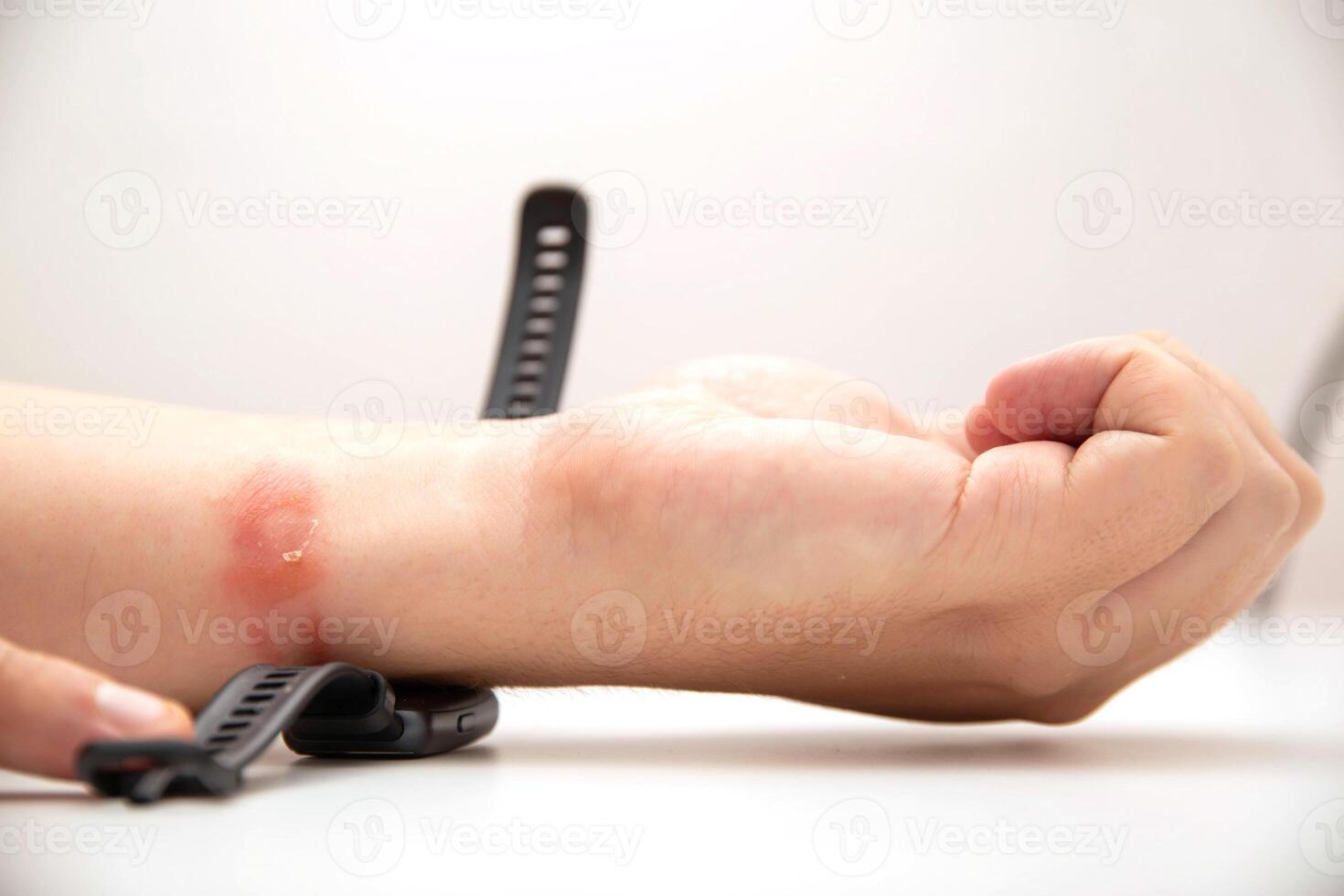 A fitness bracelet with a silicone strap taken from a person s hand. Redness, irritation and itching on the hand from the watch strap. Allergic contact dermatitis, close-up photo