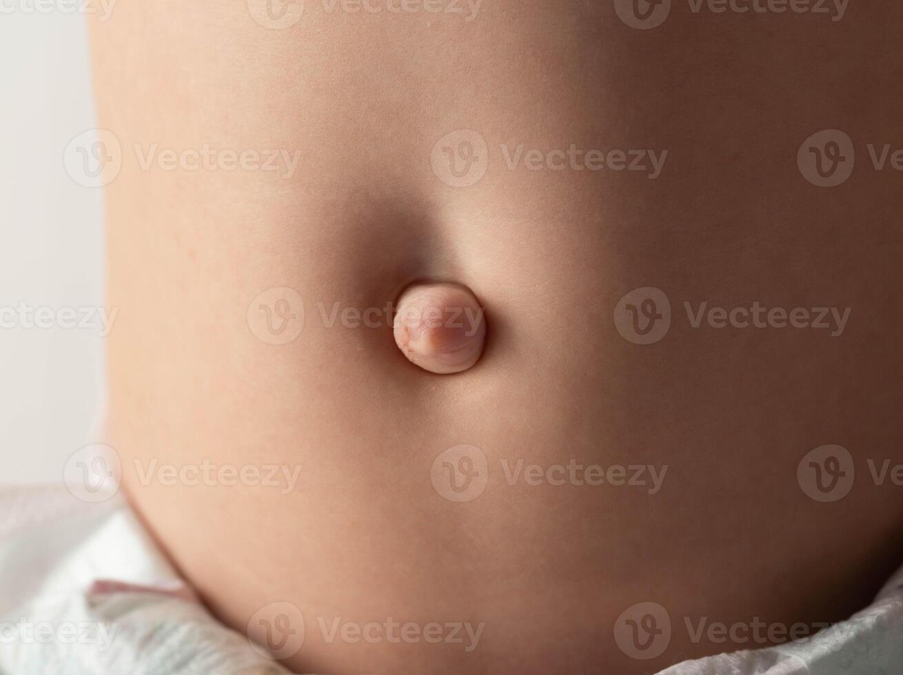 Umbilical hernia in a newborn baby on the stomach. Treatment of umbilical hernias in children without surgery, medical. Close-up photo