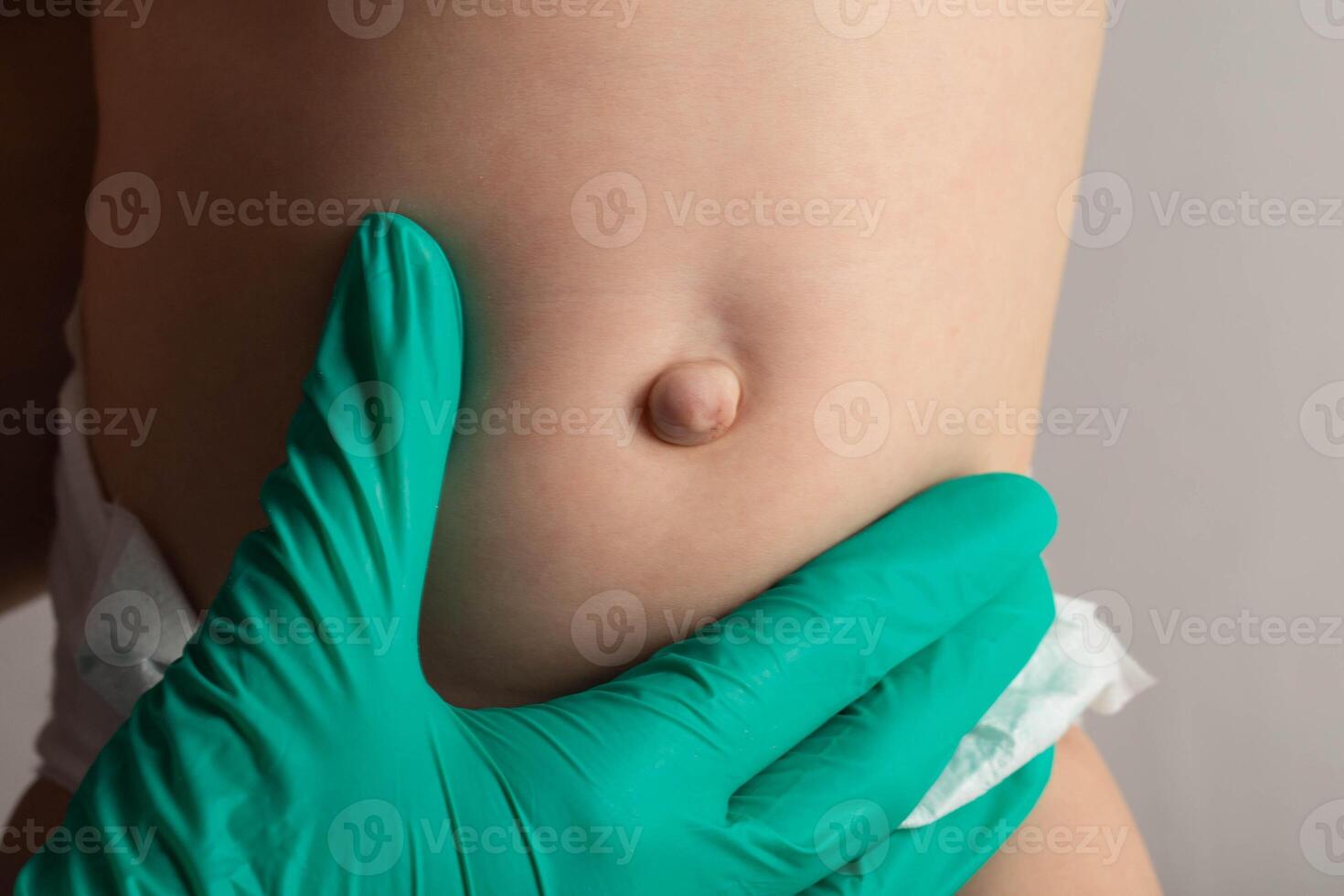 Doctor's hands in green medical gloves examine an umbilical hernia in a child, close-up. photo