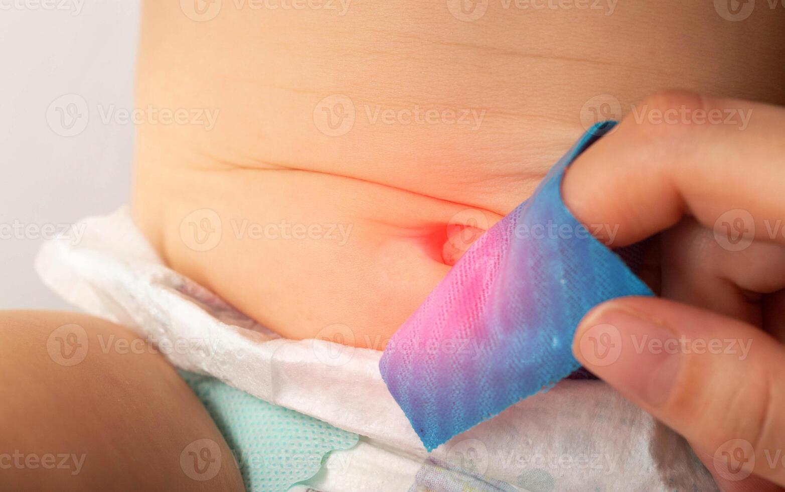 Mother's hands seal the umbilical hernia of a newborn child with a blue plaster. Treatment of an enlarged umbilical ring without surgery, close-up photo