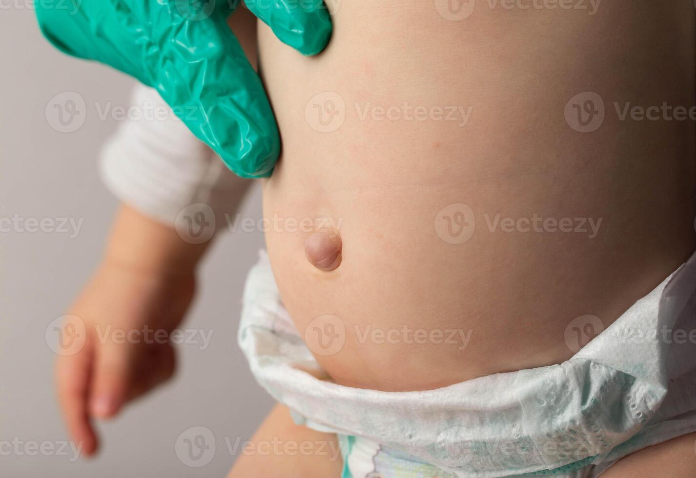 Doctor's hands in green medical gloves examine an umbilical hernia in a child, close-up. photo