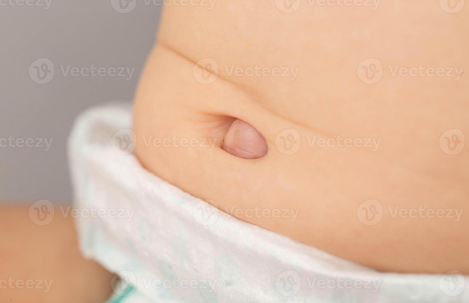 Umbilical hernia in a newborn baby on the stomach. Treatment of umbilical hernias in children without surgery, medical. Close-up photo