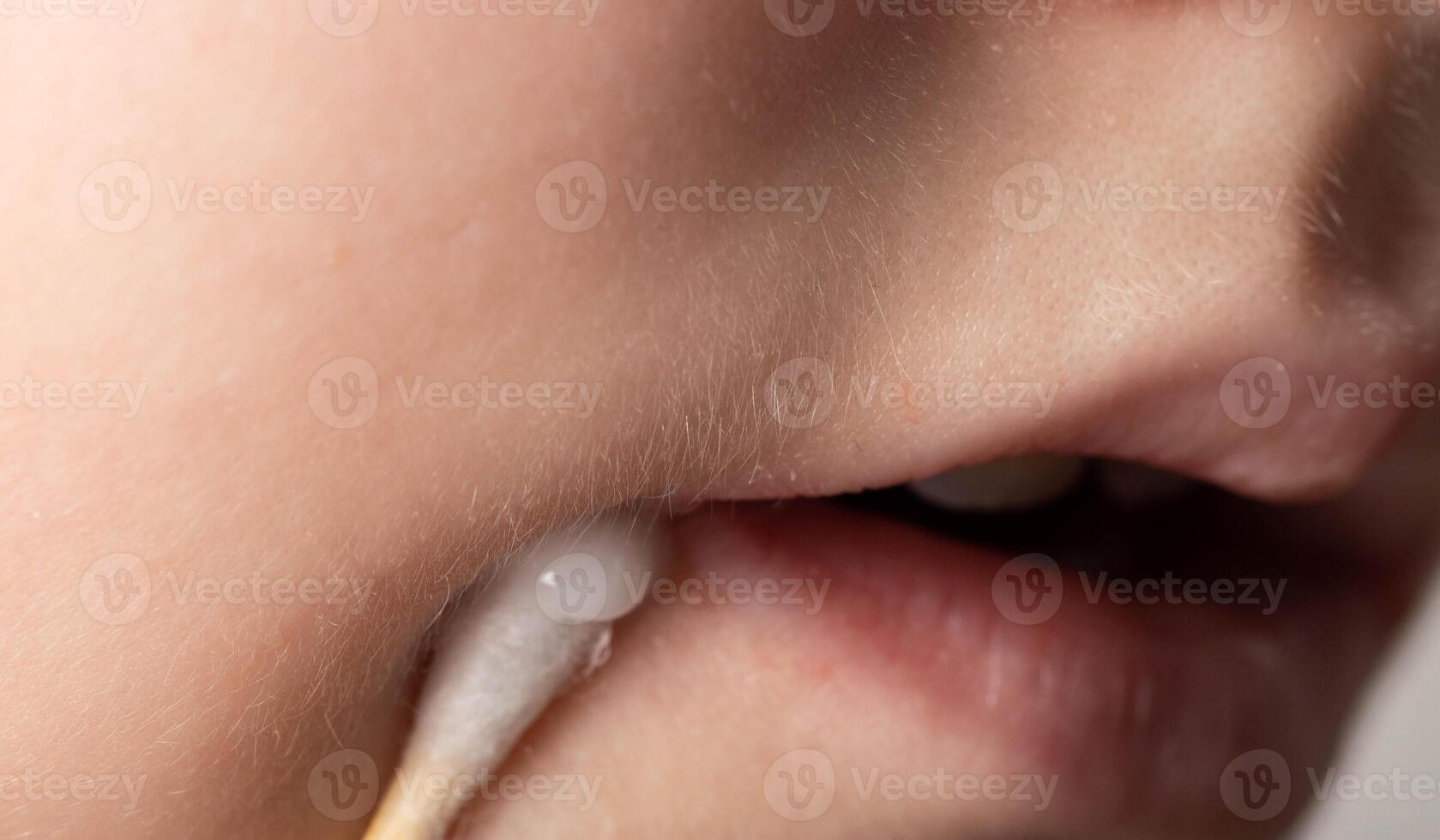 Treatment with ointment for a dermatological disease in the corners of the mouth and lips of a little girl. Treatment of seizures, herpes and angular stomatitis photo