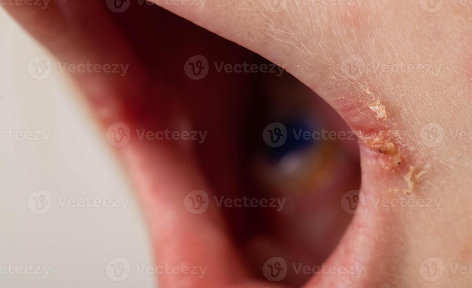 Seizures on the corners of the lips of a child s mouth. Bacterial disease of inflammation of the corners of the lips. Angular stomatitis with reduced immunity in a child, macro photo